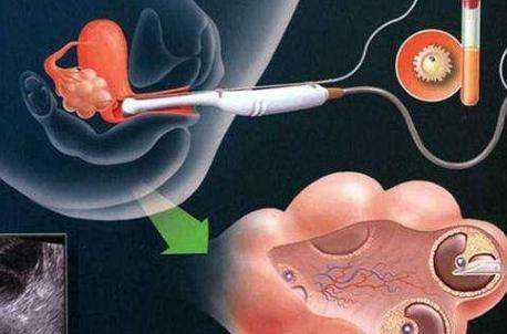 海淀卵巢早衰借卵助孕生孩子费用_试管婴儿是怎么回事做试管婴儿对女性来说