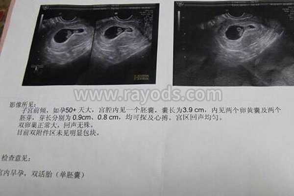 湘潭43岁三代试管_漫长的试管婴儿之路，B超单上终于看到“双活胎”