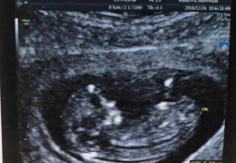 郑州助孕平台 2022郑州试管婴儿医院排名 ‘胎儿做四维生长指标能判断男女吗’